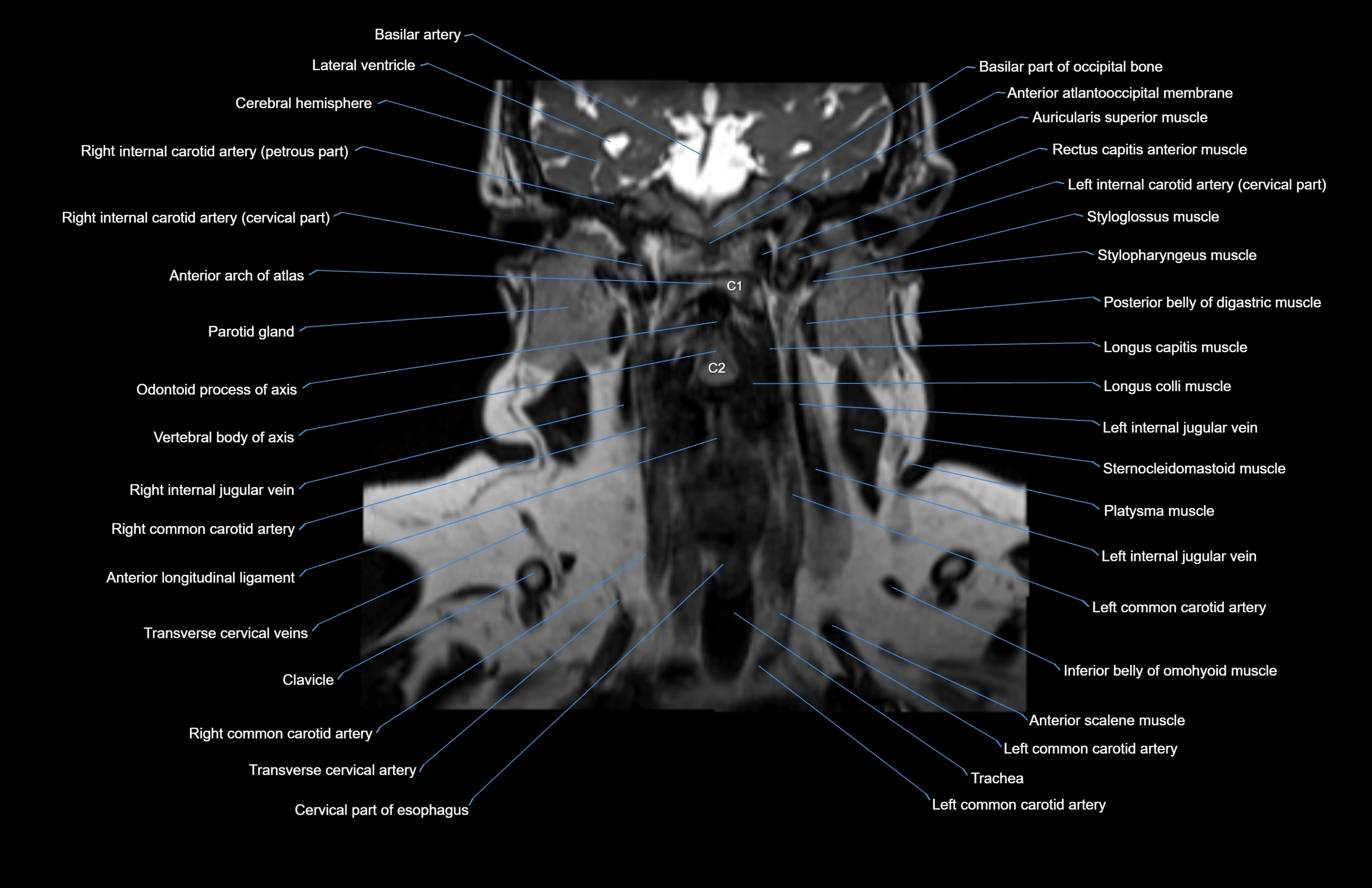 Neck coronal cross sectional MRI anatomy 3T MRI  image-img-00001-00035.webp